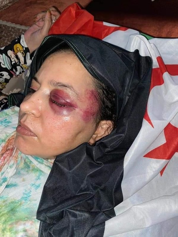 Imagen de los resultados de una agresión que sufrió hace unas semanas Sultana por parte de la policía marroquí.